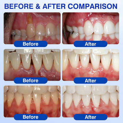 🔥Buy 2 Get 1 FREE & 🚚FREE Shipping - Advanced Enamel & Gum Care